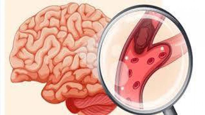 كيفية الوقاية من الجلطة الدماغية